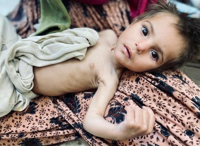 Afghanistan starving child
